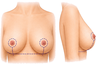Brustverkleinerung: anatomische Vorder- und Seitenansicht mit Schnittmarkierungen