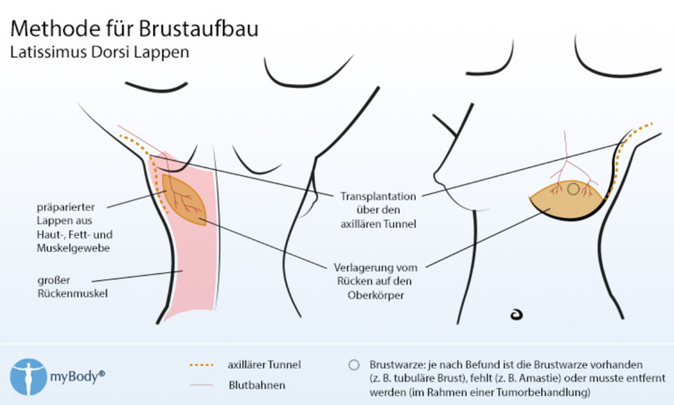 Tafel: Methode für Brustaufbau mit Latissimus-Dorsi-Lappen — präparierter Lappen aus Haut-, Fett- und Muskelgewebe, Transplantation über den axillären Tunnel
