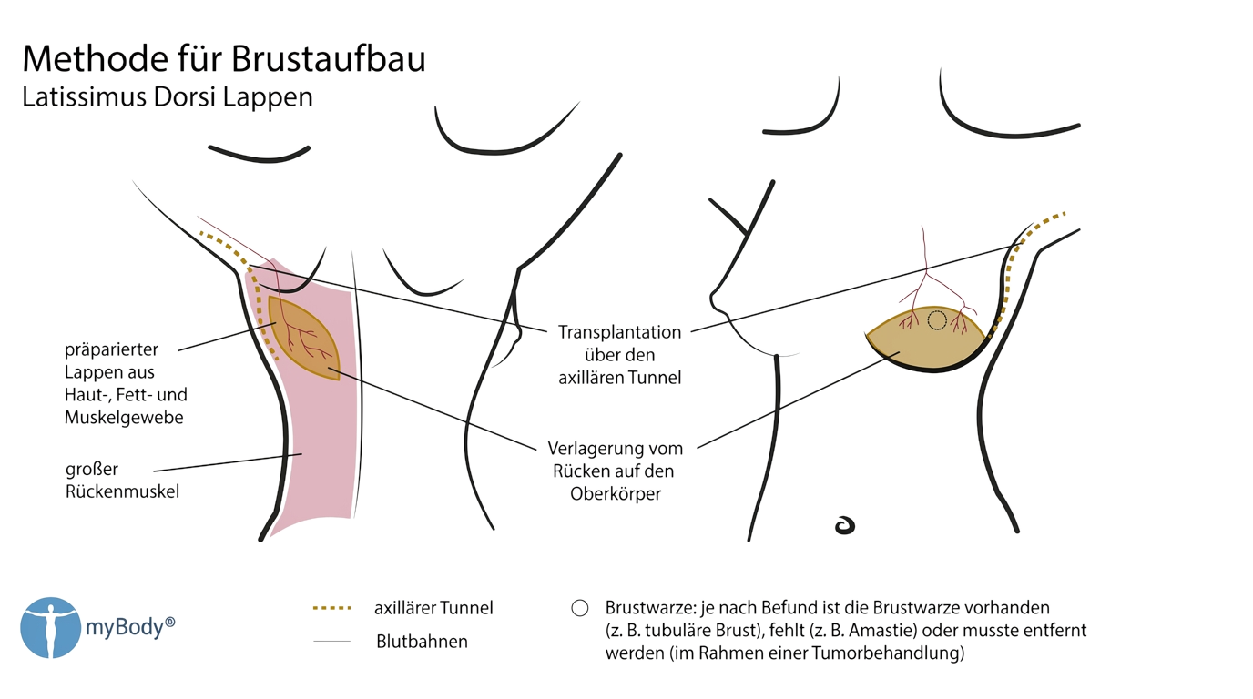 Methode für Brustaufbau: Latissimus-Dorsi-Lappen — präparierter Lappen aus Haut-, Fett- und Muskelgewebe, Transplantation über den axillären Tunnel